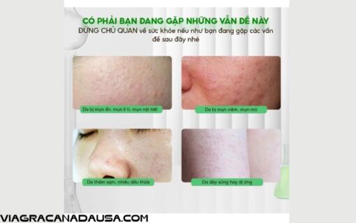 Bột Ngũ Hoa thuốc Bắc đắp mặt nguyên chất giúp giảm mụn